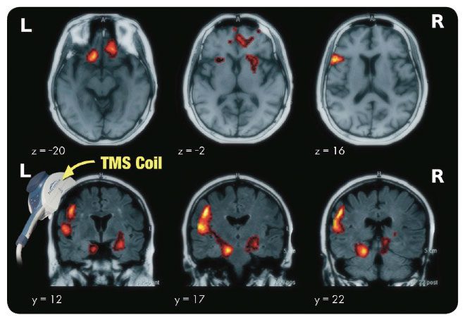 TMS Therapy for Alcohol Addiction Treatment and Recovery are Closely Related