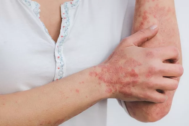 Rash from Crack Use